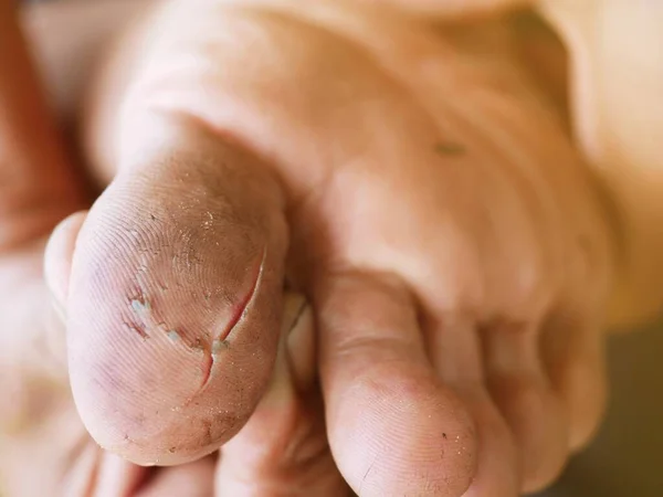 Wound Has Been Cut Sharp Object — Stock Photo, Image