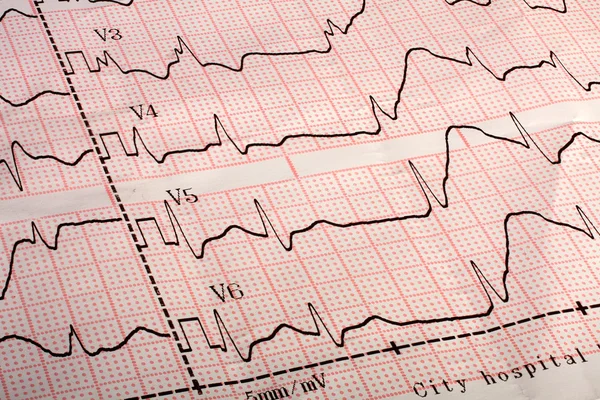 Impressões eletrocardiográficas ECG — Fotografia de Stock