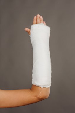 Kırık bir kol alçıda gri arka plan üzerinde Close-Up. 