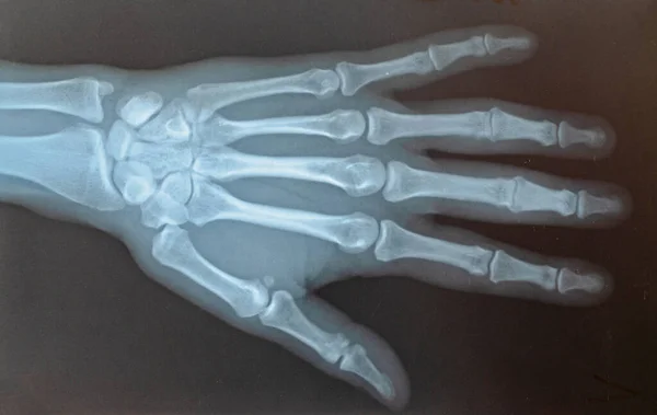 Radiographie Main Après Traitement Contracture Wanstein — Photo