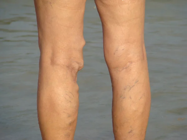 Varicose veins of the legs — Stock Photo, Image