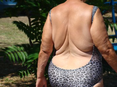 selülit, yanlış beslenme den vücudun obezite.