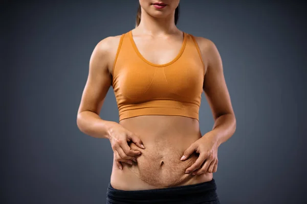 Giovane Mamma Che Tiene Pancia Piena Smagliature Dopo Gravidanza — Foto Stock