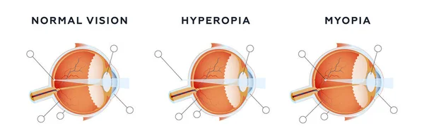 Látászavarok Normális Látás Hyperopia Miópia Modern Lapos Vektor Illusztráció Részletes — Stock Vector