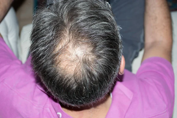 A young man with a bald spot in the office of a trichologist cosmetologist. Bald on a man's head. Male pattern baldness. Fighting hair loss in men