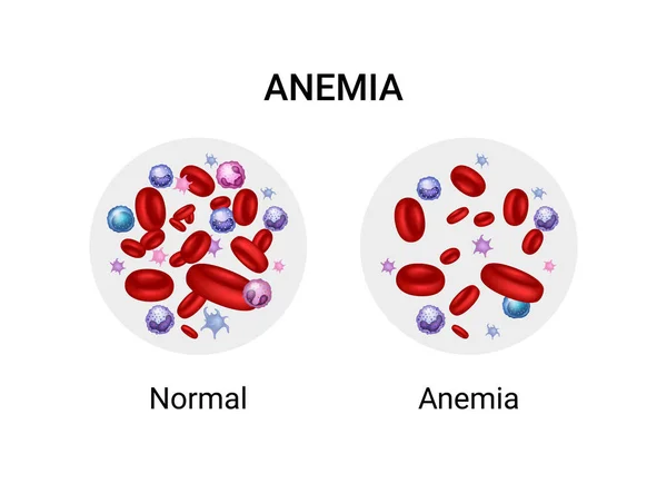 Vector Illustration Difference Number Healthy Red Blood Cells Anemia Normal — 图库矢量图片