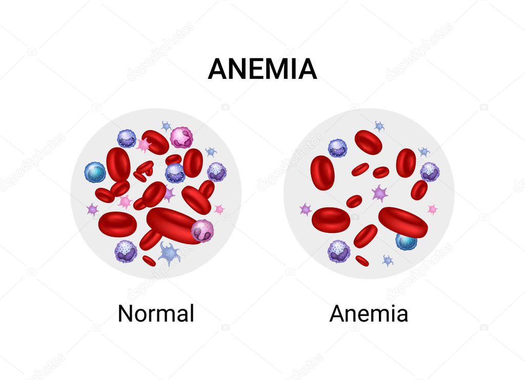 Vector illustration of the difference of number of healthy red blood cells. Anemia and normal.