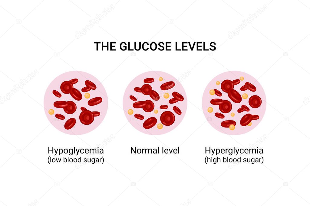 Vector illustration of glucose levels in the blood. Hypoglycemia. Hyperglycemia.