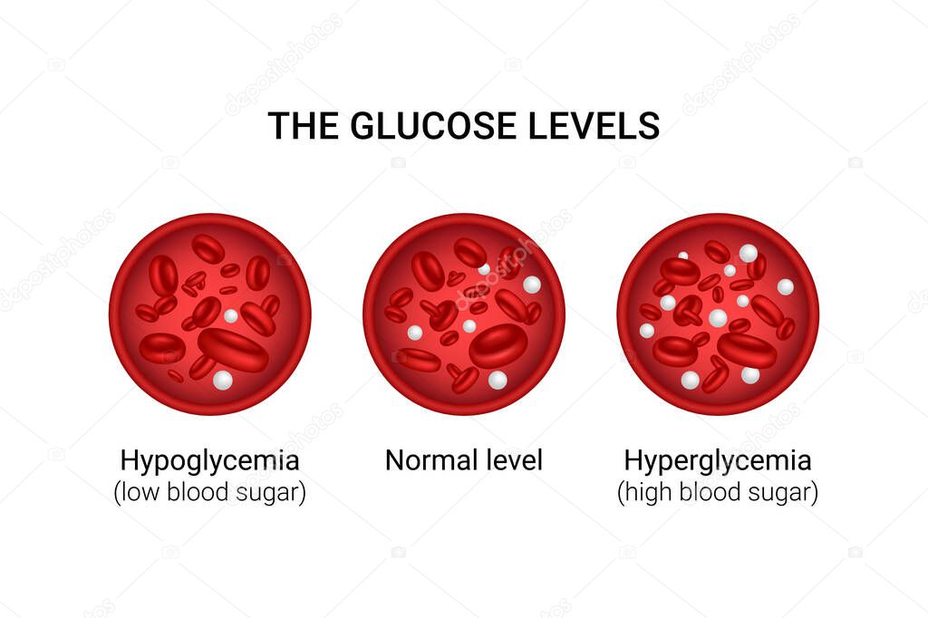 Vector illustration of glucose levels in the blood. Hypoglycemia. Hyperglycemia.