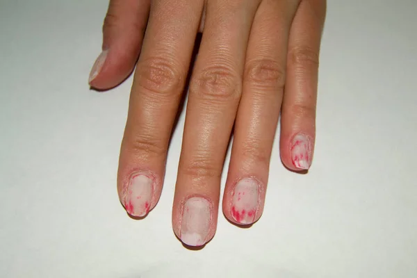 nails on a woman's hand after polishing. the remains of nail polish