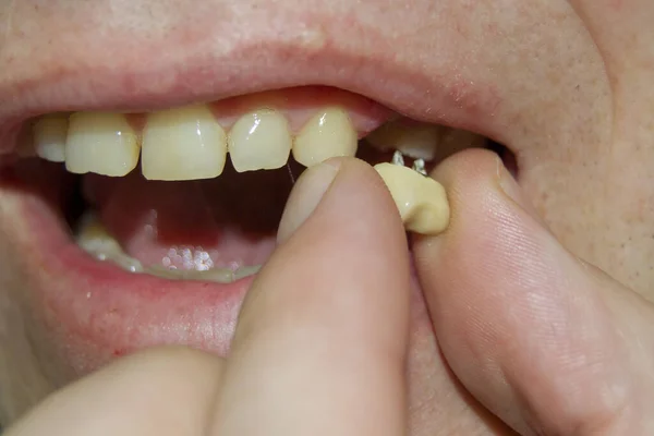 Kırık diş implantı. Bir dişin sakızı göçmüş.