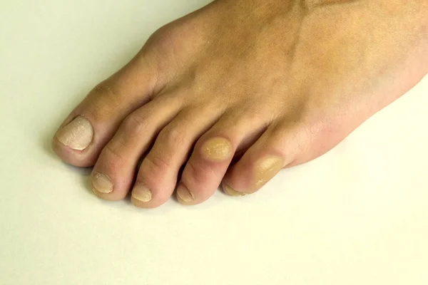 Κάλους Στα Δάχτυλα Των Ποδιών Από Κοντά Πόδι Ενός Άνδρα — Φωτογραφία Αρχείου