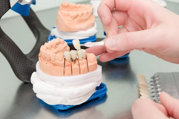 Kaplama diş implant diş bir laboratuvar kontrol