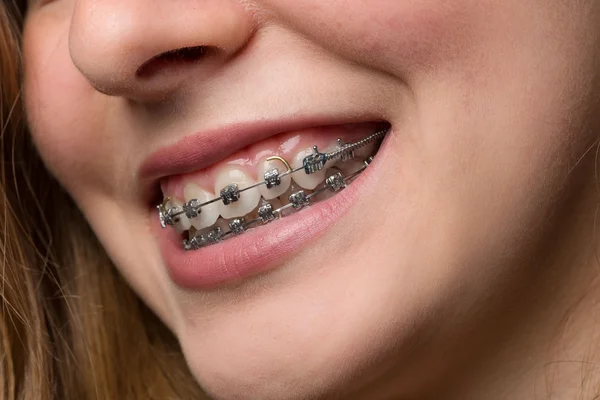 Teenager mouth with dental brace — Stock Photo, Image