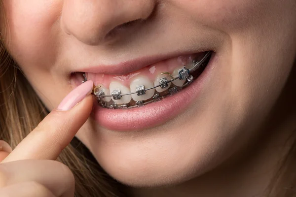 Mulut remaja dengan penjepit gigi — Stok Foto