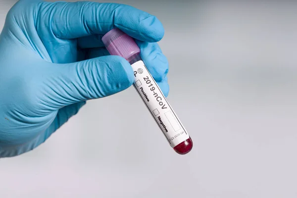 Mão Luvas Azuis Segurando Tubo Teste Sangue Coronavírus Frente Laboratório — Fotografia de Stock