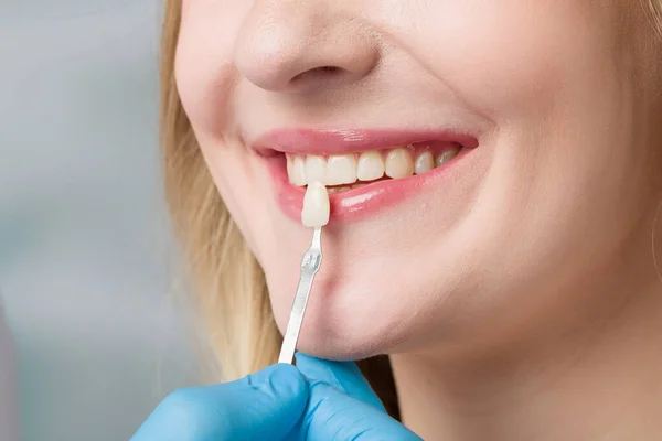 Закрыть Рот Женщины Руку Стоматолога Помощью Направляющего Проверки Шпона Зубов — стоковое фото