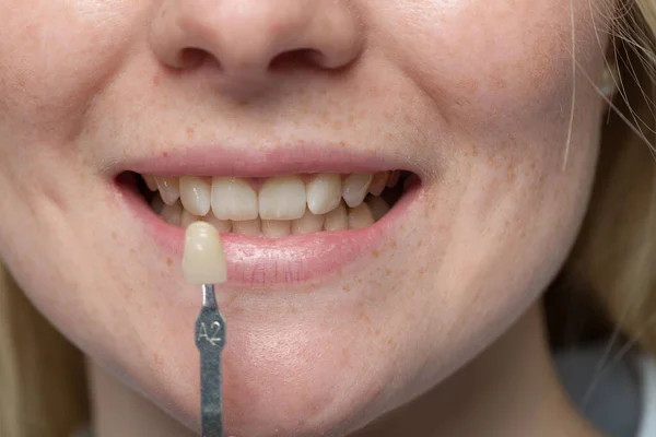 Close Usar Guia Sombra Boca Mulher Para Verificar Folheado Dente — Fotografia de Stock