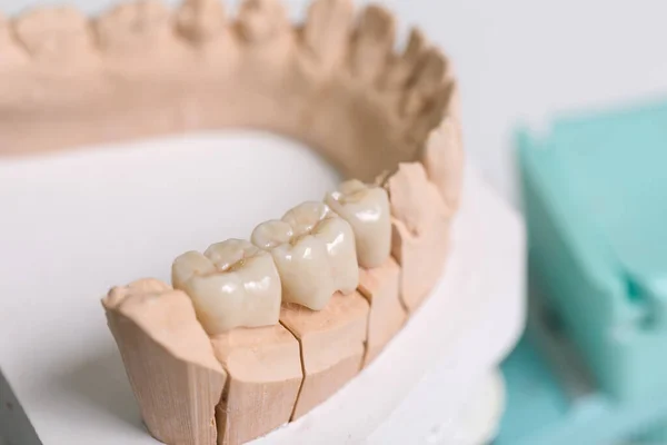 Primo Piano Dell Impronta Dentale Con Dentizione Artificiale Laboratorio Odontoiatrico — Foto Stock
