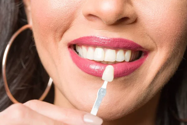 Close up of dentist\'s hand using shade guide at woman\'s mouth to check veneer of teeth for bleaching