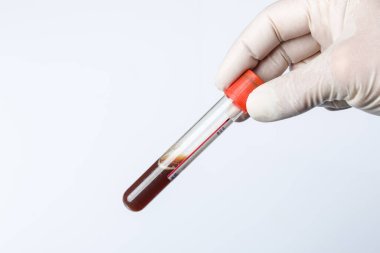 Laboratuvarda incelemek için bir kan sondasını kullanma.