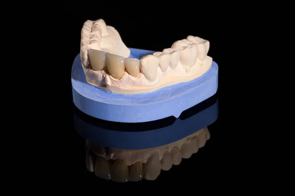 Primo Piano Della Dentizione Artificiale Una Rady Impronte Dentali Uso — Foto Stock
