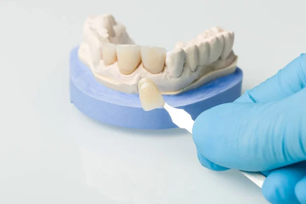 牙科化验室用遮阳导引检查牙冠或植入物的贴面 — 图库照片