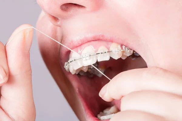 Рот с зубной скобой — стоковое фото
