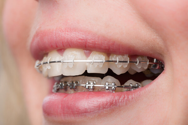 Mouth with a dental brace