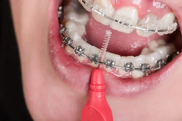 Rengöring en mun med en dental stag — Stockfoto