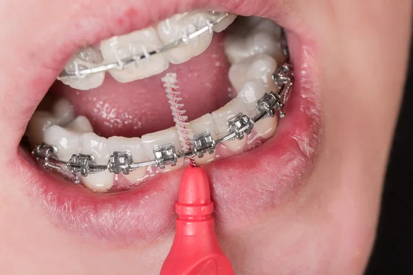 Penjepit Dental — Stok Foto