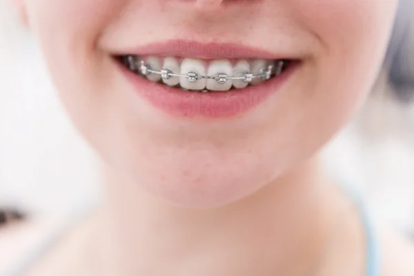 Dental brace — Stock Photo, Image