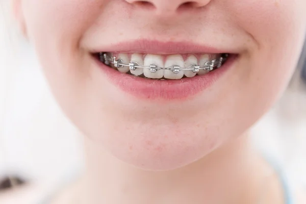 Dental brace — Stock Photo, Image