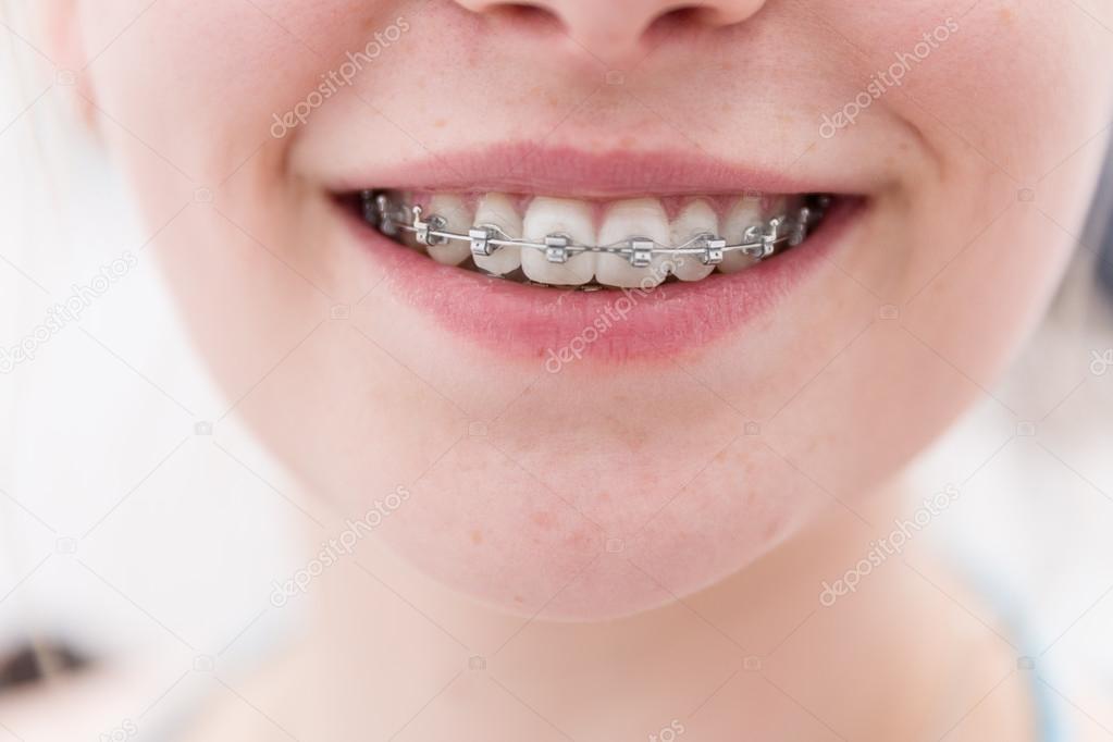 Dental brace — Stock Photo © StudioaMagica 71806761