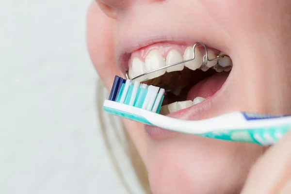 Limpieza de dientes con un corsé dental — Foto de Stock