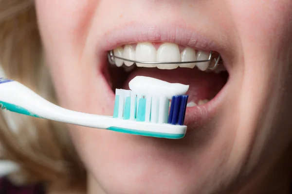 Nettoyage des dents avec un appareil dentaire — Photo