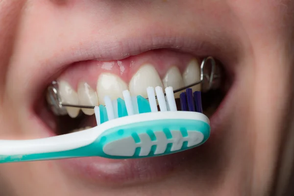 Очистка зубов с помощью зубной скобки Стоковое Изображение