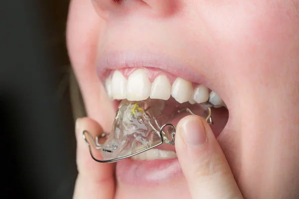 Justera en dental stag — Stockfoto