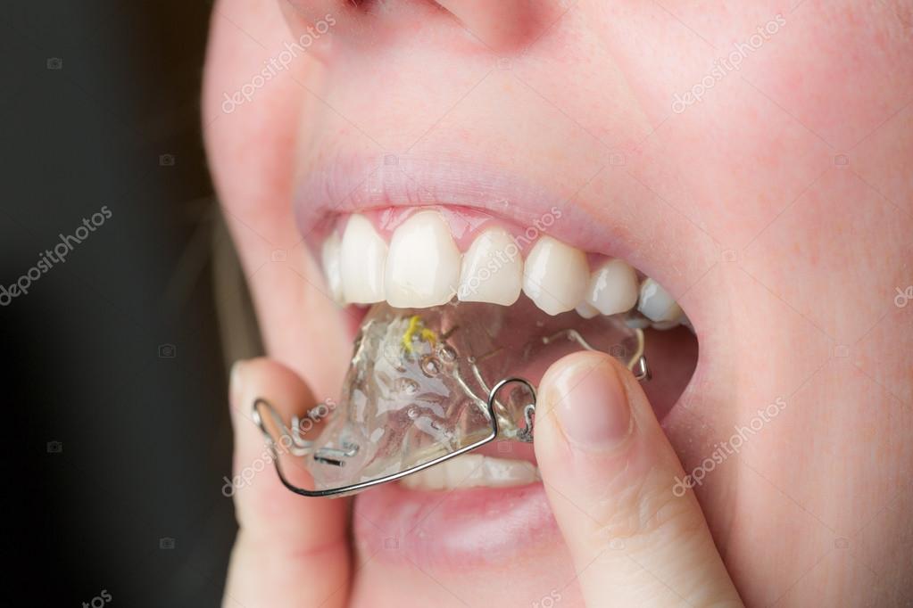 Поставили пластину на зубы. Ретейнер ортодонтический Капа. Двухчелюстной ортодонтический аппарат. Скобы пластинки для зубов. Пластина для выпрямления зубов.