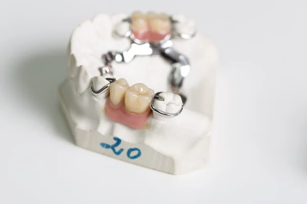 Сідло протеза в стоматологічній лабораторії — стокове фото