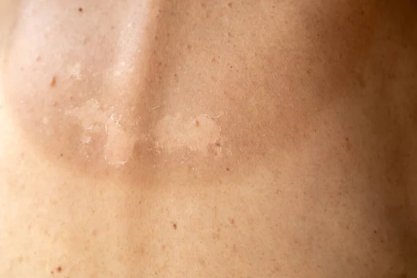 Burnt skin, birthmarks and texture. Beauty and health