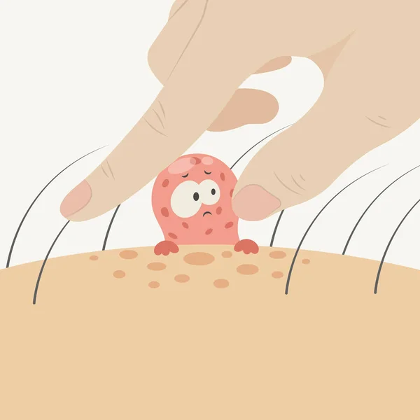 Pimple Popping Wektor Ilustracji — Wektor stockowy