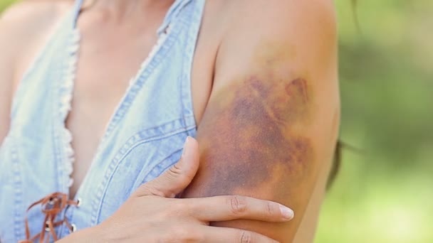 Girl stroke-oars on huge bruise. — Stock Video