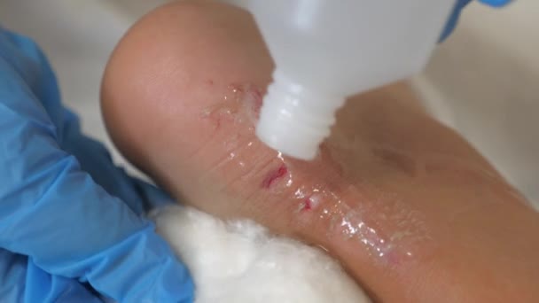 Disinfection of wound, abrasion on a persons leg. Provision of first medical aid. Heel of an injured young child. Traumatologists office, examination of patient with minor trauma. Treatment and help — Stock Video