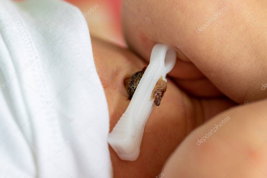 A close up portrait of a black and brown umbilical or navel cord pinched off and dying away by a clip. This way the belly button of the child is formed.