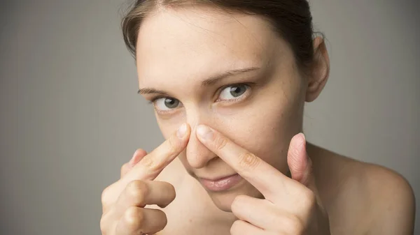 Ragazza Con Acne Cura Della Pelle — Foto Stock