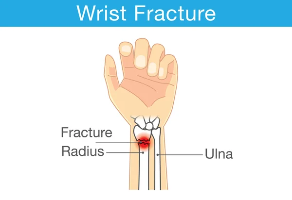 Diagrama de la muñeca tiene fractura ósea . — Vector de stock