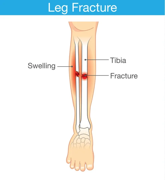 Diagrama da fratura da perna —  Vetores de Stock