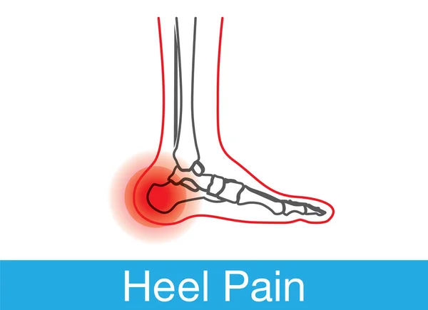 Esquema de dolor en el talón — Vector de stock