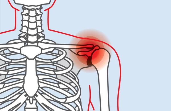 Esquema de dolor en el hombro — Vector de stock